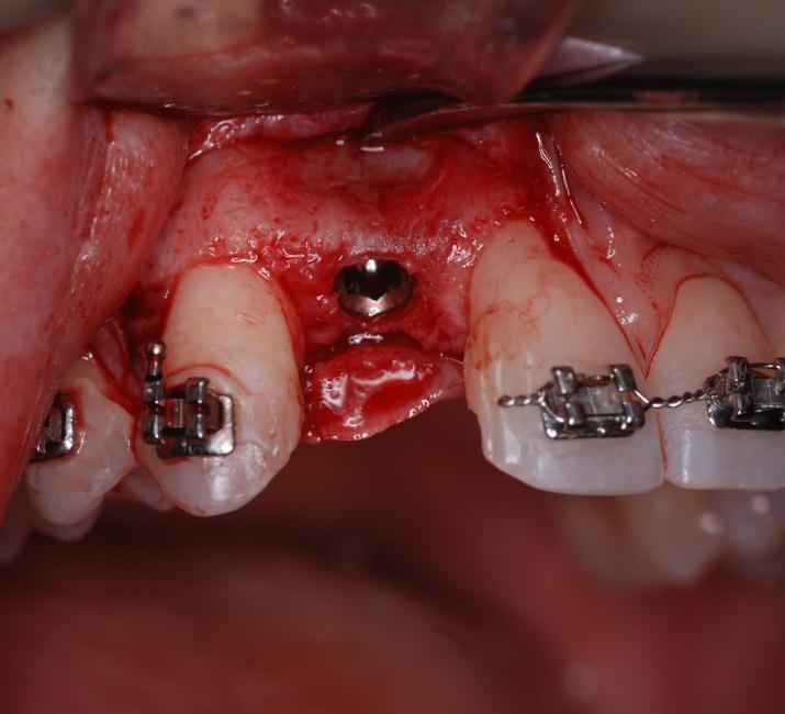 The fixture mount is removed from the implant and prepared for use as a