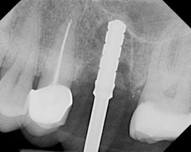 Dr. Edgard El Chaar Periapical radiograph of the paralleling post