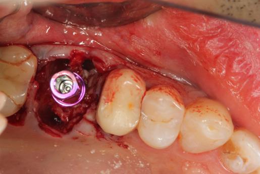 Dr. Edgard El Chaar A Zimmer Trabecular Metal Dental Implant, 4.