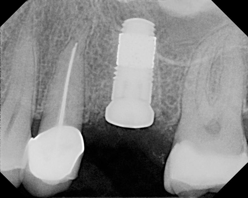 Dr. Edgard El Chaar Periapical radiograph shows the Zimmer