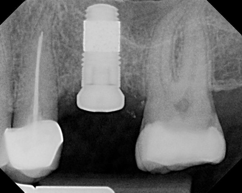 Dr. Edgard El Chaar Periapical radiograph taken at two months after the Zimmer Trabecular Metal Dental Implant placement shows a
