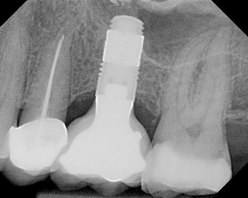 Dr. Edgard El Chaar Periapical radiograph of Trabecular Metal Dental Implant with