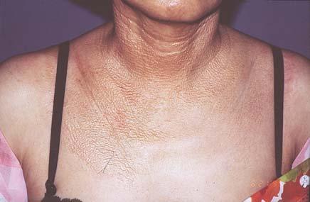 A B INTRODUCTION Pseudoxanthoma elasticum-like papillary dermal elastolysis (PXE-PDE) and white fibrous papulosis of the neck (WFPN) share several similarities.