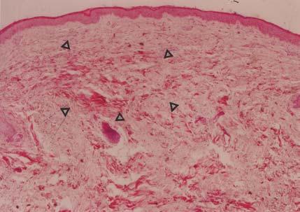 and eosin (H & E) stain, but a complete bandlike loss of elastic fibers in the papillary dermis along with focal elastogenic change in the subpapillary or mid-dermis under the orcein stain were noted