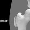 Hip: Trochanteric bursa injection