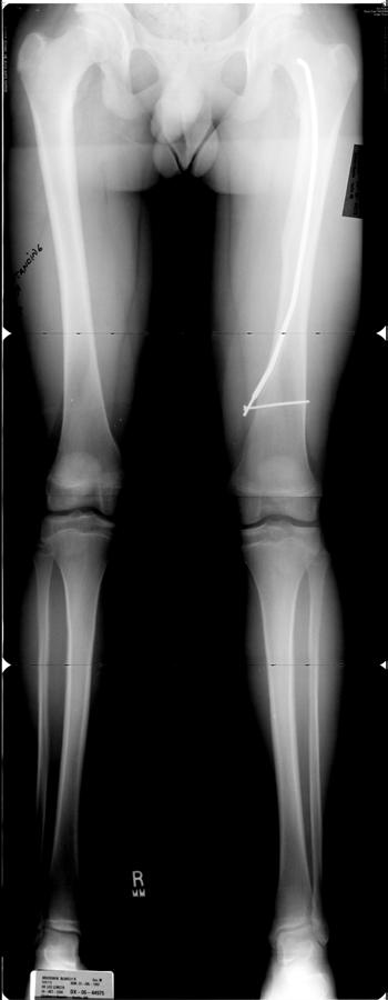 Diaphyseal femur fracture retained flexible nail 4-5 years after implantation: painful prominent hardware difficult to remove