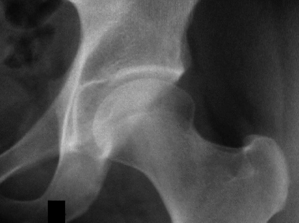 A retroverted hip is demonstrated on a coned-down anteroposterior