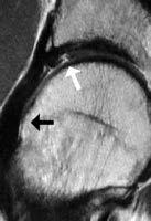 offset Full-thickness loss of articular