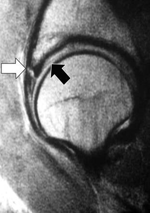 labral-chondral transitional zone. Peters C. L.