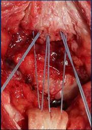 bone trough bi-directional fixation to the distal pole
