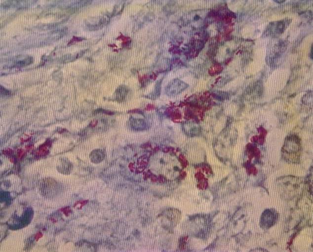 epithelioid cells Absence of caseative necrosis, calcification in