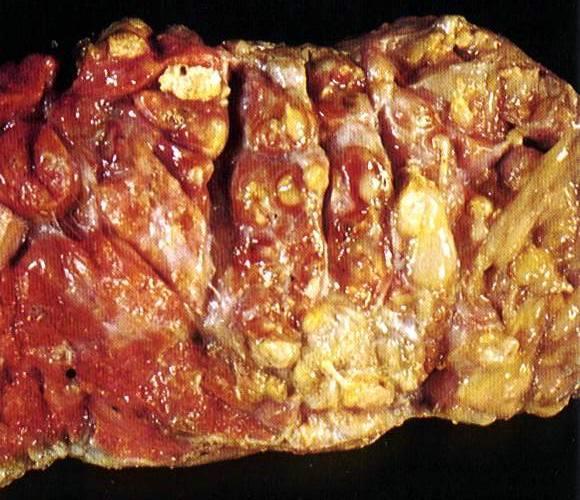 mass Granulomatous lesions in spleen, lymph nodes, liver
