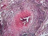 TUBERCULOSIS Microscopic features Granulomatous