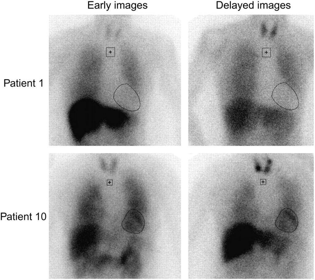 MIBG MYOCARDIAL SCINTIGRAPHY I-MIBG images in early and delayed phase in 2 patients with probable DLB.