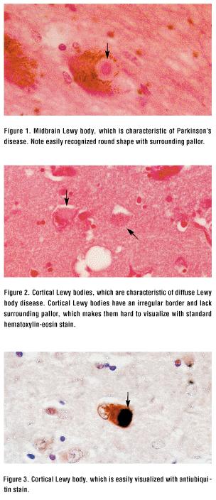 Diffuse Lewy body disease was first described by