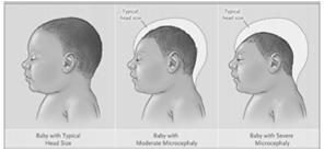 Microcephaly Smaller than average head Fetal neurological damage o Underdeveloped brain o Impaired hearing and sight Greatest risk during 1 st trimester Causes include o Alcohol / drug abuse o