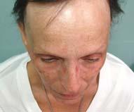 Variant of lichenplanopilaris Exam reveals progressive recession of frontotemporal hair line with loss of follicular openings Atrophy of frontal scalp/forehead with vessel prominence Perifollicular