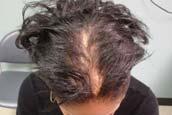 Over half of study participants reported symptoms at baseline 55% reported breakage of hair