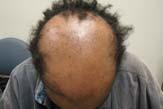 Dlova et al, Autosomal dominant inheritance of central centrifugal cicatricial alopecia in black South Africans.