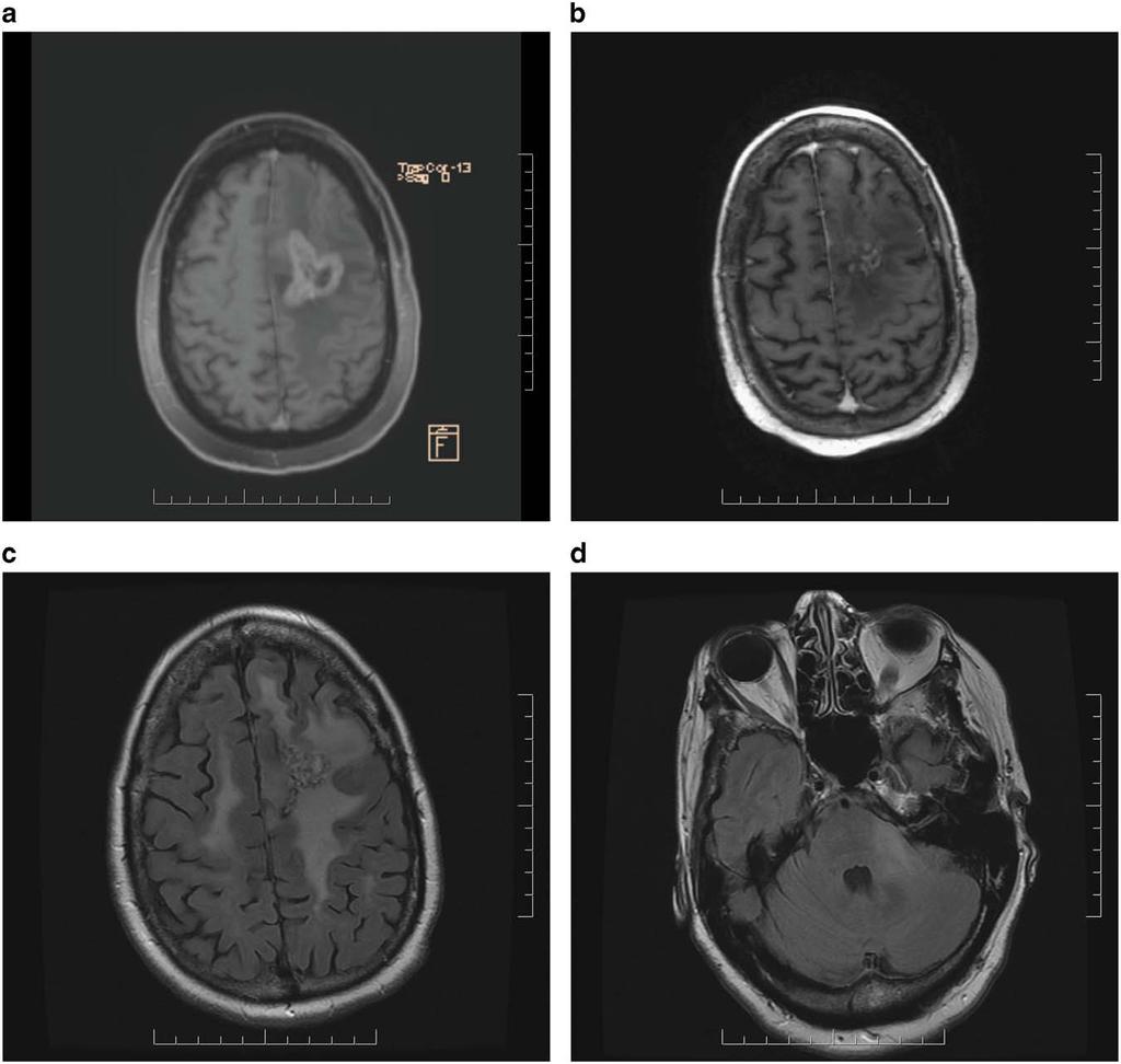 THE CANADIAN JOURNAL OF NEUROLOGICAL SCIENCES Figure 2: (a) Contrast-enhanced axial Ti-weighted MR scan demonstrates enhancing tumour and surrounding edema in left frontal lobe.