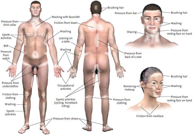 vitiligo induction and therapy model:double-blind,