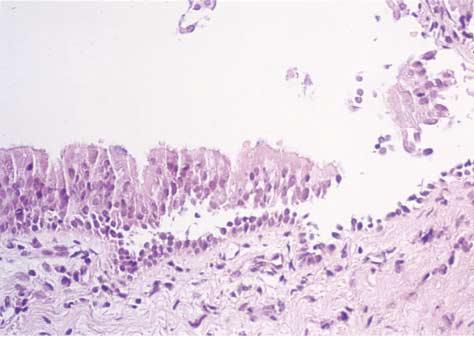 Respiratory Epithelium in PNP Loss of