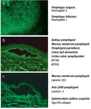Indirect Immunofluorescence/ELISA Schmidt and Zillikens, The Diagnosis and