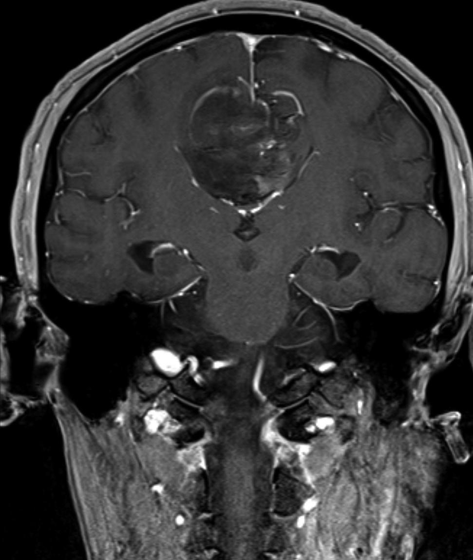 B, C, and D: One year later, follow-up MRI shows a heterogeneously enhanced mass associated with bleeding in right cingulate gyrus on axial (B), sagittal (C), and coronal (D) images of enhanced