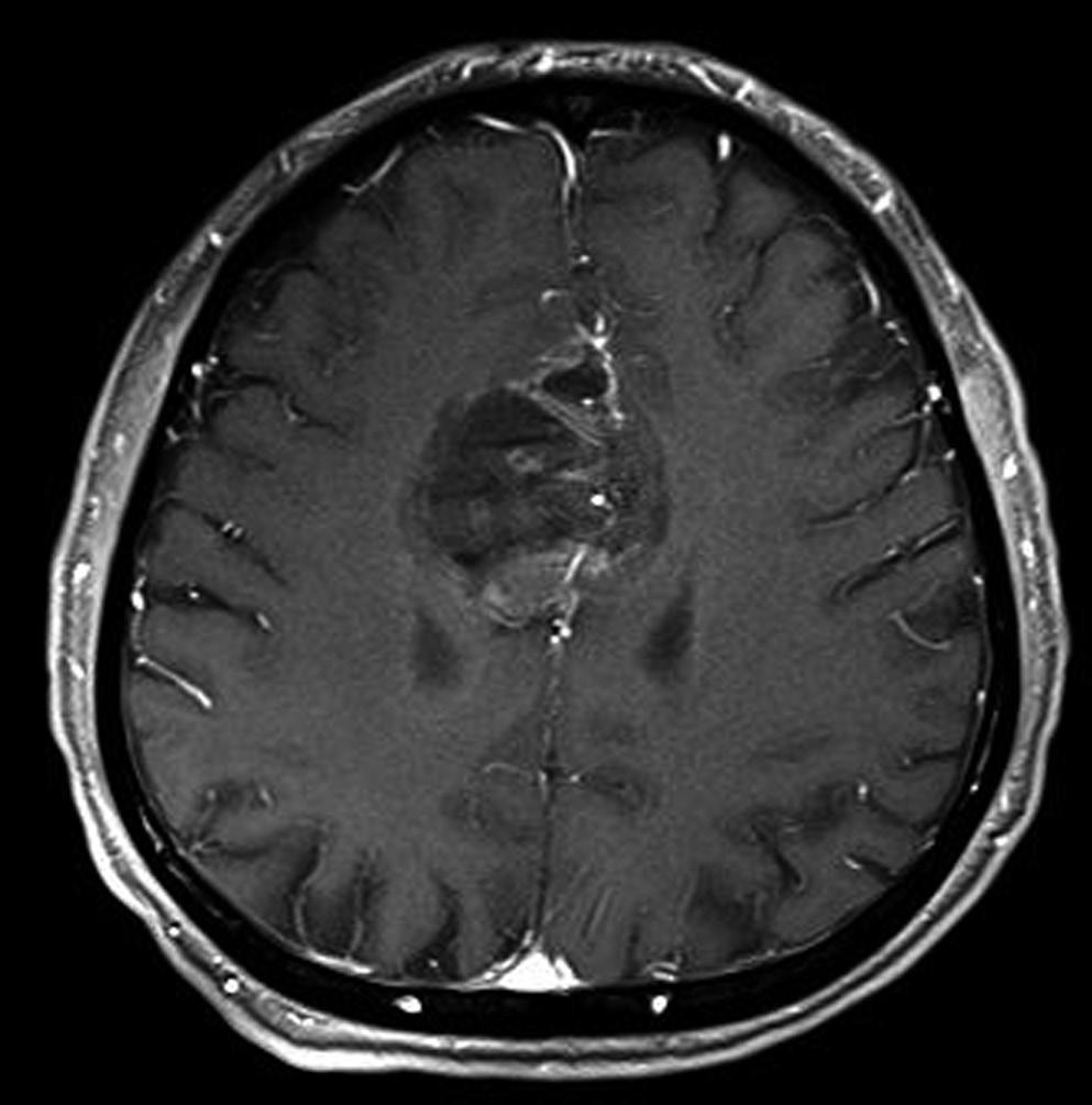 F: Brain MRI shows a homogenous enhanced lesion in the left frontal base on axial view of enhanced T1-weighted image. (Contiuned to the next page) F and a ventriculoperitoneal shunt was placed (Fig.