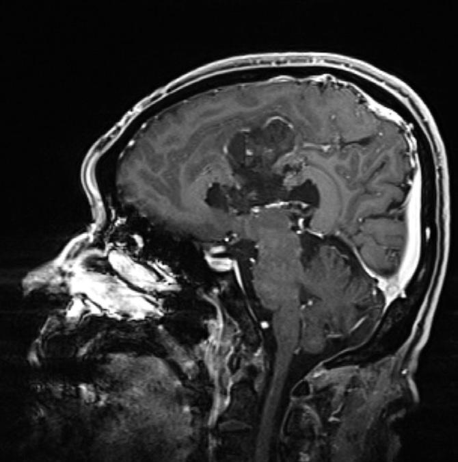 Re-radiation therapy of 50 Gy was administered to the recurrent lesion on the left frontal base. After radiotherapy, all brain lesions were stable (Fig. 1K).