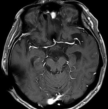 J: After surgery and chemotherapy, the mass of left frontal base was recurred on axial view of enhanced T1-weighted image.