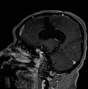 Pathologically, gliosarcoma is defined as a glioblastoma variant consisting of an admixture of gliomatous and sarcomatous components, and presents in around 2% of glioblastoma cases [1,2].