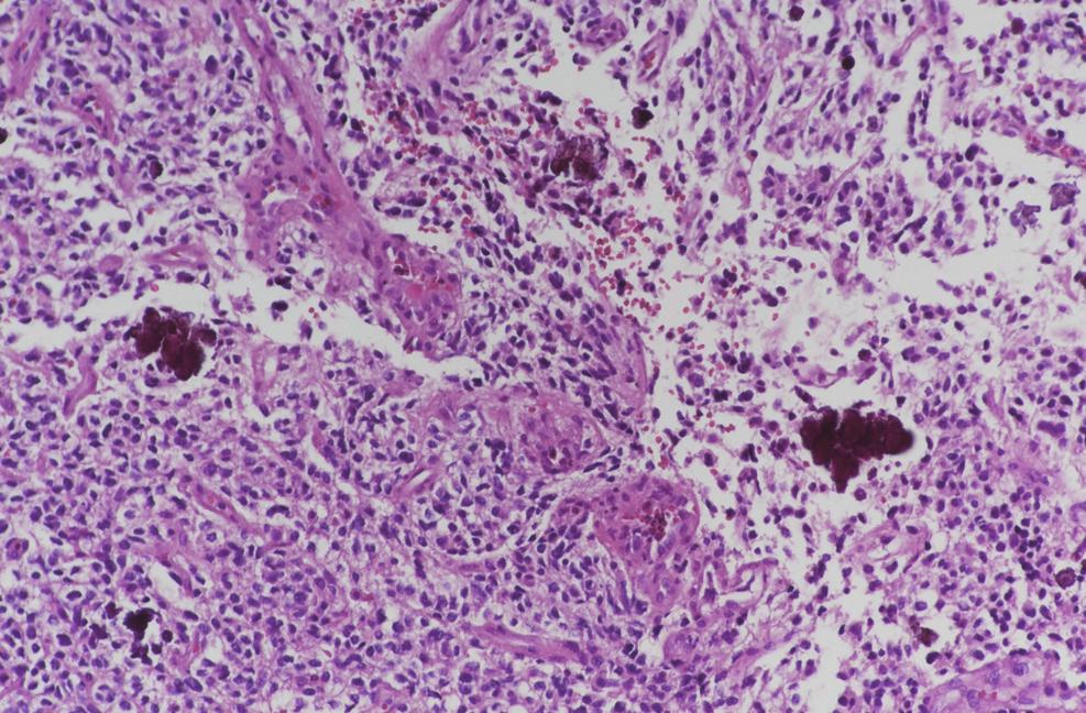 Gliosarcoma with Extracranial Metastases required because of the propensity for