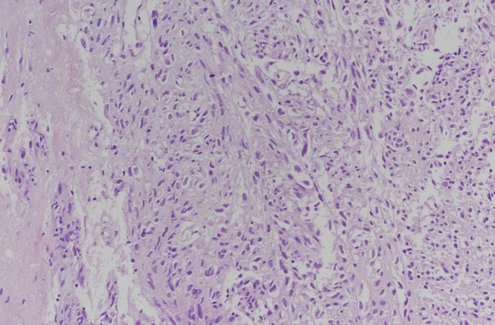 In most cases, the distant metastases are associated with a recurrence of gliosarcoma.
