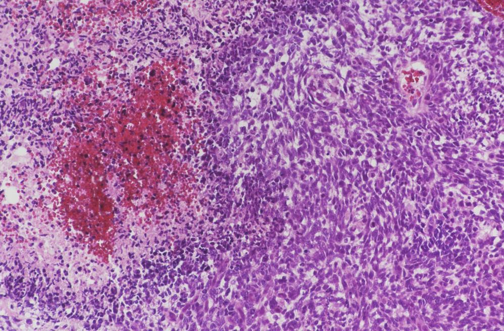 Pathologic findings of glioblastoma and gliosarcoma within brain and liver.