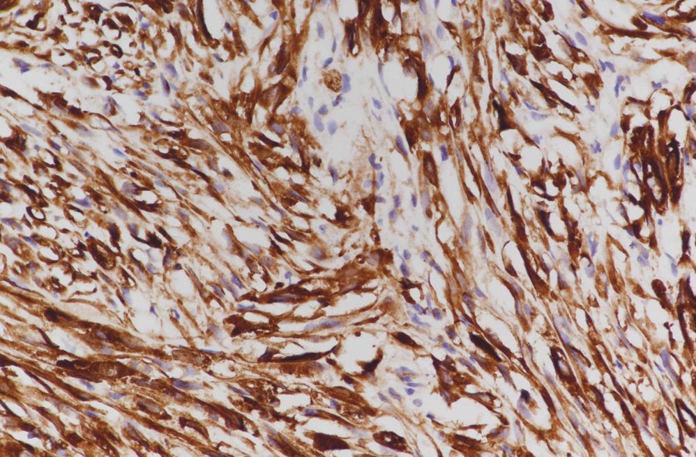 Gliosarcoma of brain; the glial component of pleomorphic astrocytic cells (C, original