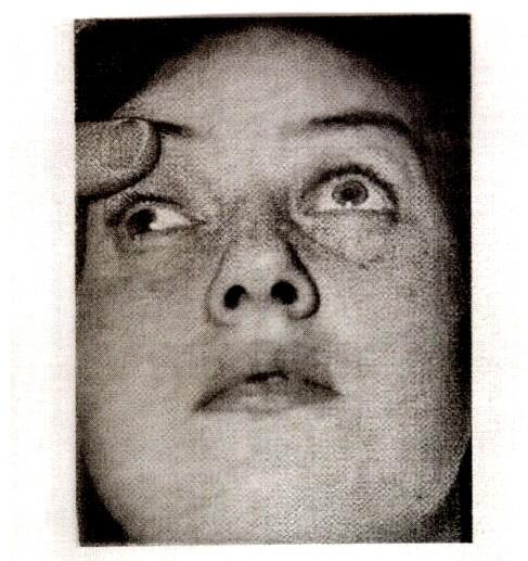 OCULOMOTOR (III) NERVE DAMAGE AT REST - LATERAL STRABISMUS (WALL- EYED) DUE TO PARALYZE MEDIAL RECTUS ALSO -