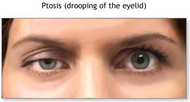 PTOSIS = DROOPING EYELID; CAN BE SIGN OF DAMAGE TO OCULOMOTOR NERVE (III) OR