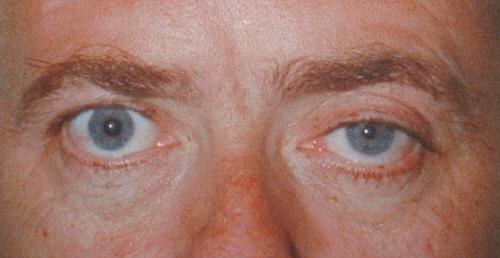 symptoms: - Pupil is dilated - denervate pupillary constrictor (mydriasis) - Also