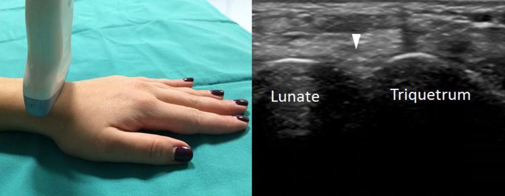 Fig. 12: Lunatutriquetral ligament. White arrowhead, lunatutriquetral ligament. Fig.