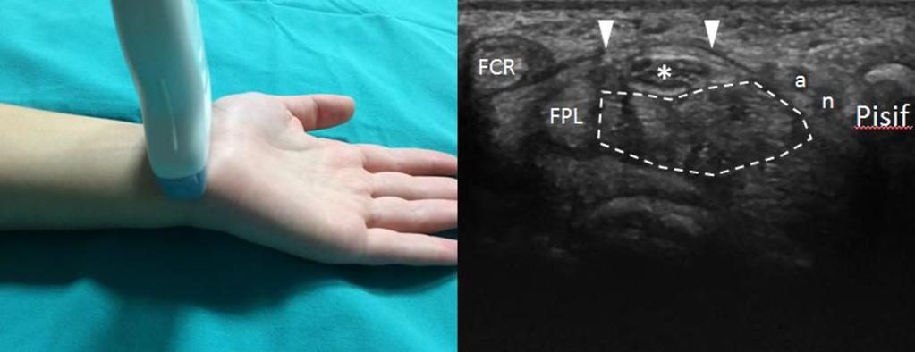 FCR, flexor carpi radialis tendon; FPL, flexor pollicis longus tendon; asterisk, median nerve;