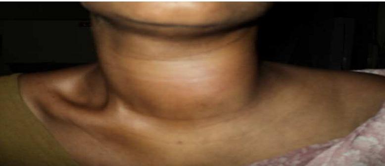 Clinical image showing neck swelling On General examination, patient is moderately built. Pallor+.