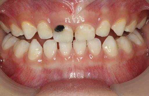 CONTINUING EDUCATION 1 CARIES TREATMENT has the advantage of being simple and easily obtaining good cooperation from young children or the elderly.
