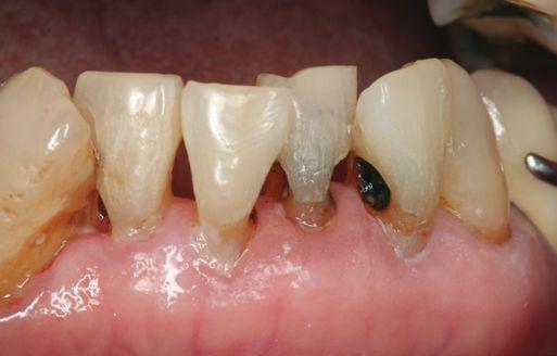 31 The present authors applied 38% SDF weekly for 3 weeks to speed up the process of caries arrest and for treatment of rampant caries.