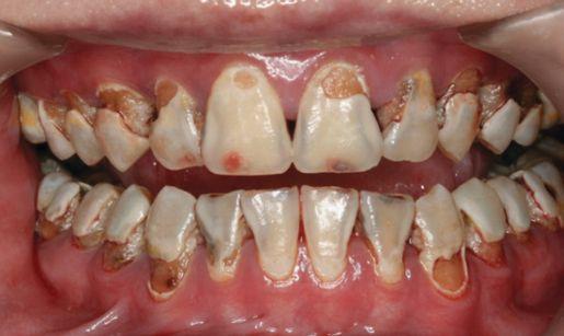 and endodontic treatment, SDF and laser irradiation can be used to strengthen dentin for caries prevention.