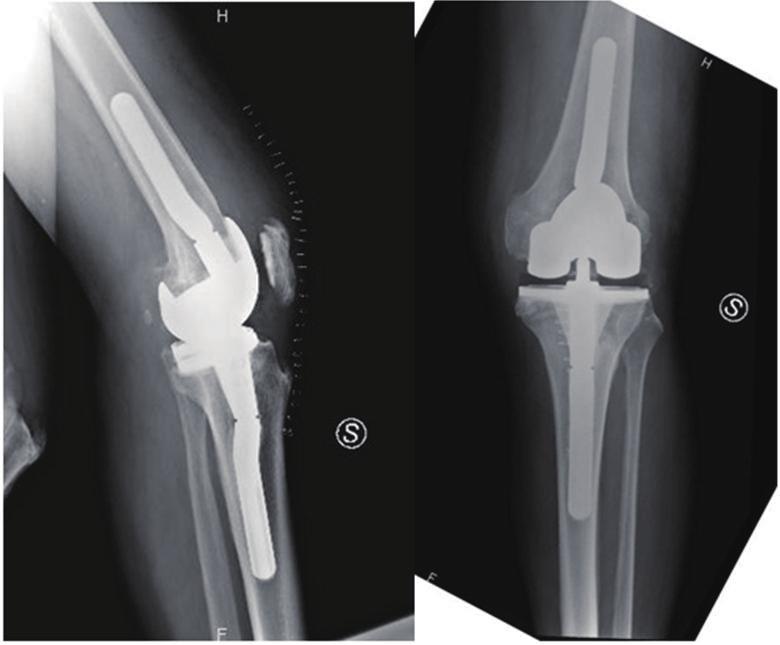 Two different types of implants were used: 10 constrained condylar knee (CCK Zimmer) and 18 TC3 (DePuy Johnson & Johnson). All patients were over 75 years old (mean 81.