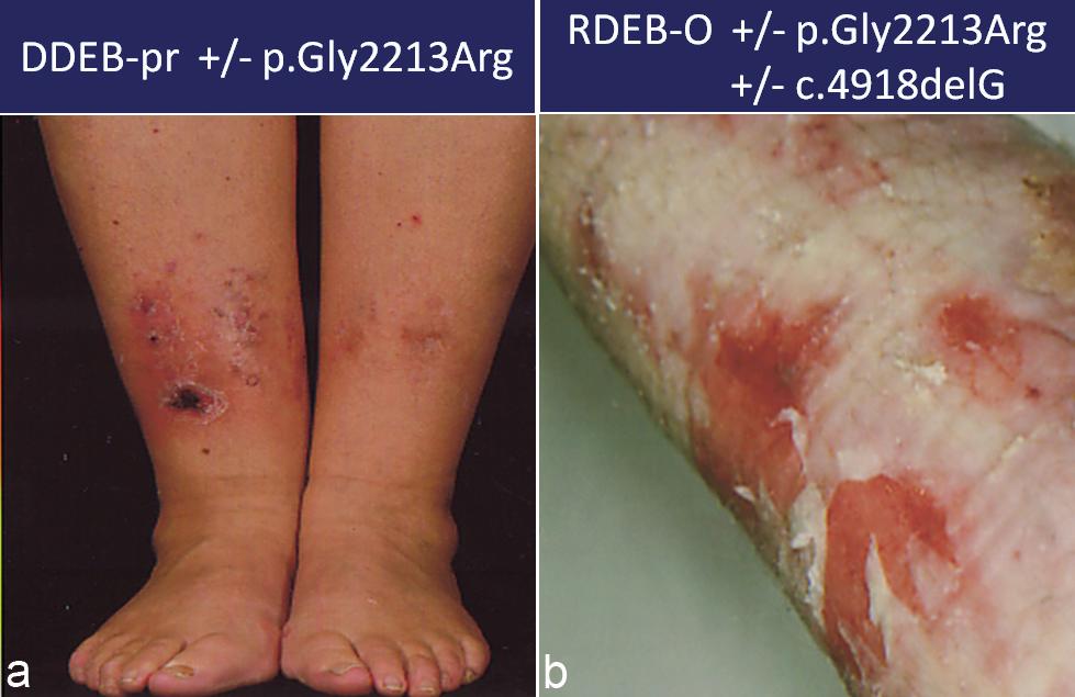 264 N. Almaani et al. abnormalities, including signs of nail dystrophy, in contrast to the previously reported heterozygous individual.
