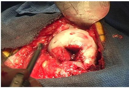 ) Nakon prikazivanja glave femura oscilirajućom pilom učini se prozor u kortikalnoj kosti na prijelazu zglobne hrskavice i vrata femura, osteotomom se odigne kortikalni prozor i uvede se