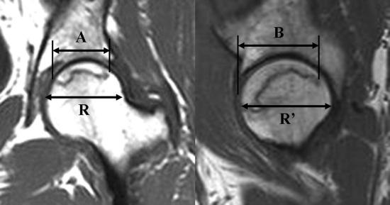 Mjeri se najveći mediolateralni promjer glave femura (R) na AP RTG snimkama ili MR u frontalnoj ravnini, najveća mediolateralna dužina nekrotične lezije (A) na MR ili AP RTG