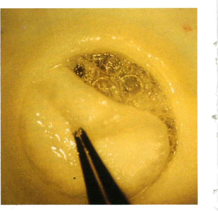 Accepted for publication 27 April 1992 British Journal ofophthalmology 1992; 76: 646-650 Deep lamellar keratoplasty on air with lyophilised tissue G K Chau, S A Dilly, C E Sheard, C K Rostron